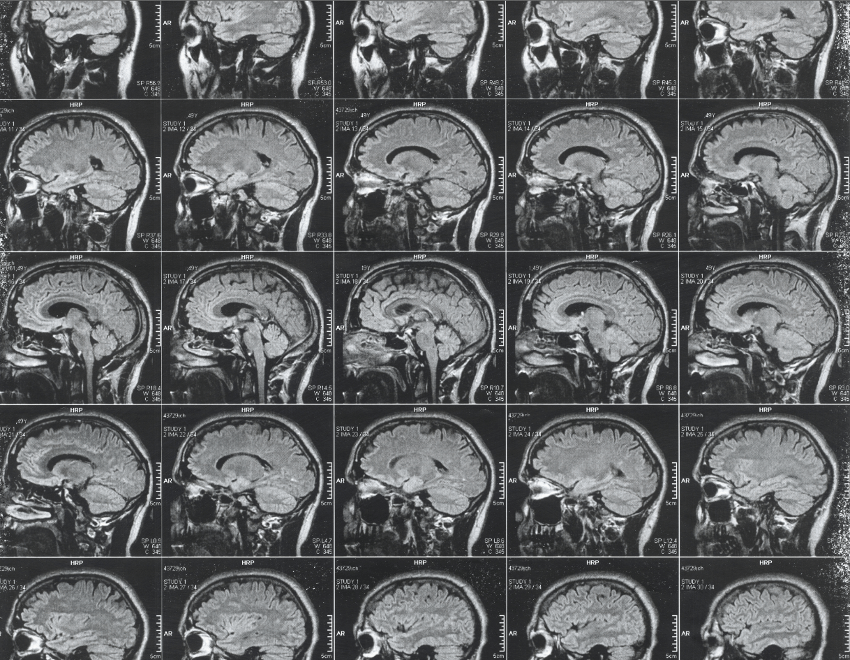 Five ways focused ultrasound is changing medicine