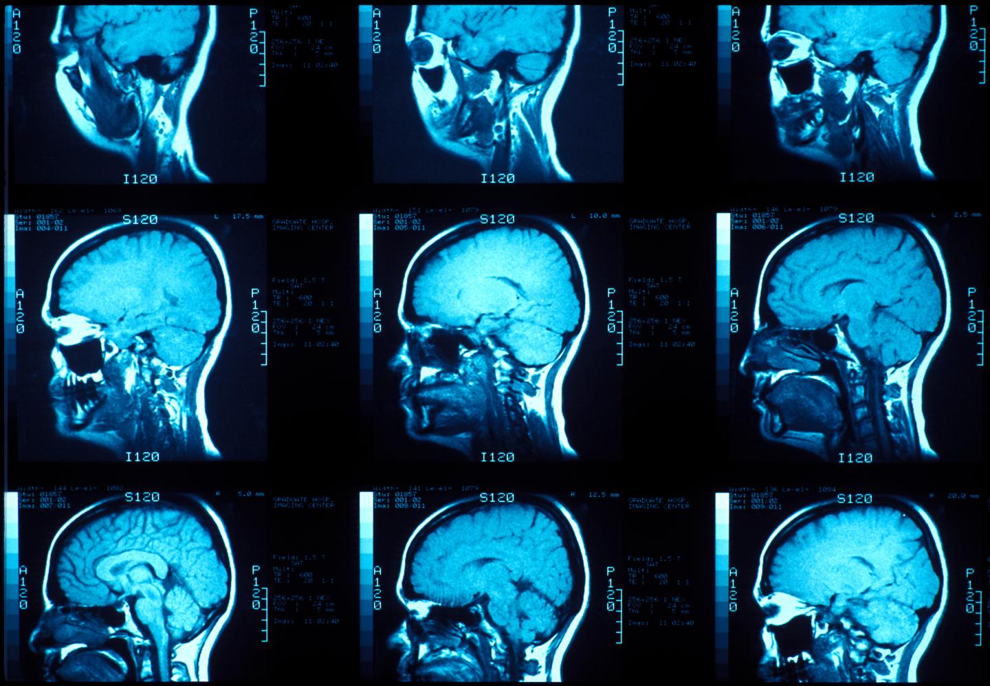 MRI of the lateral skull