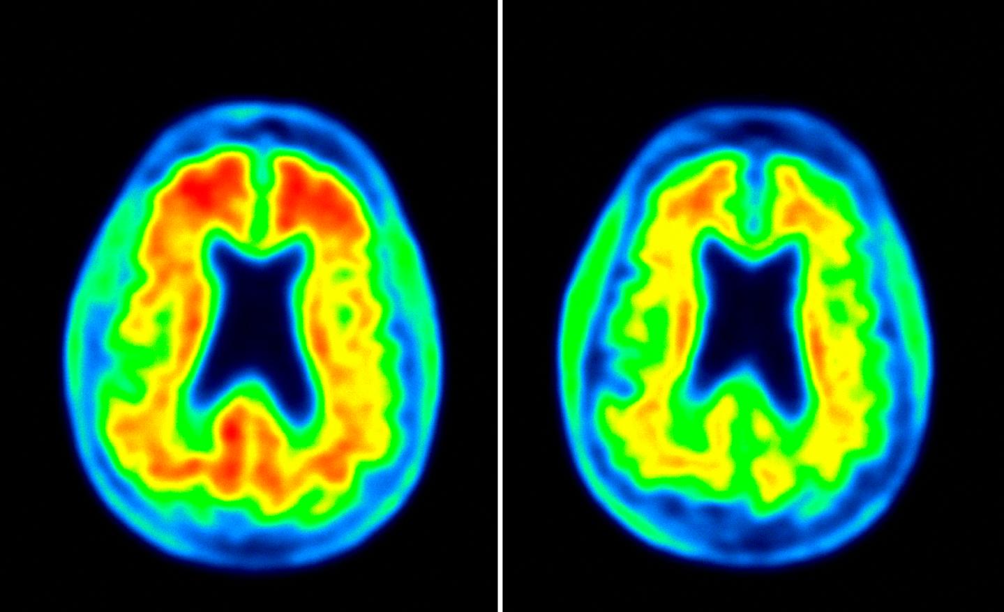 BioGen Alzheimers