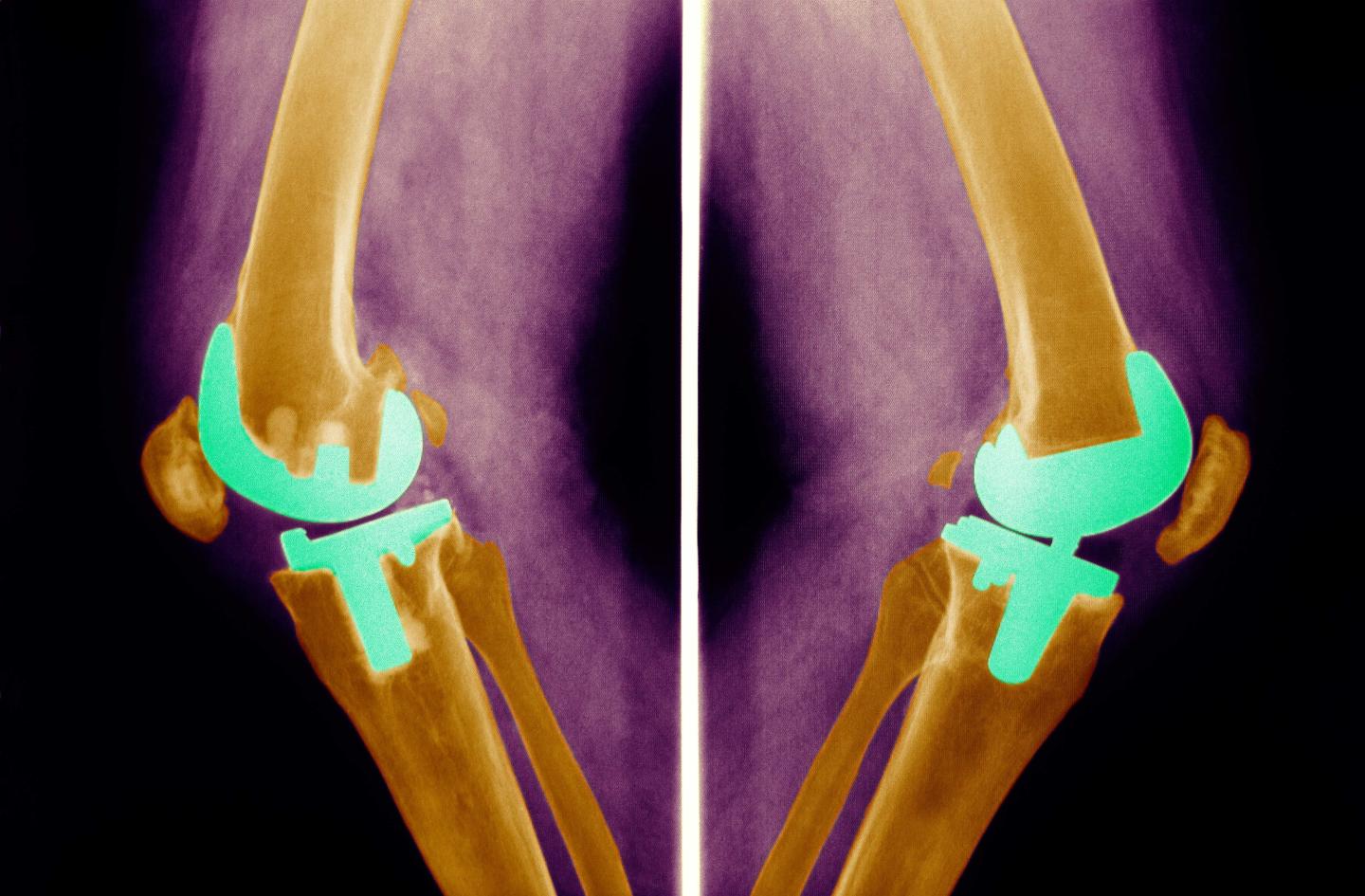 Knee Prosthesis, X-Ray