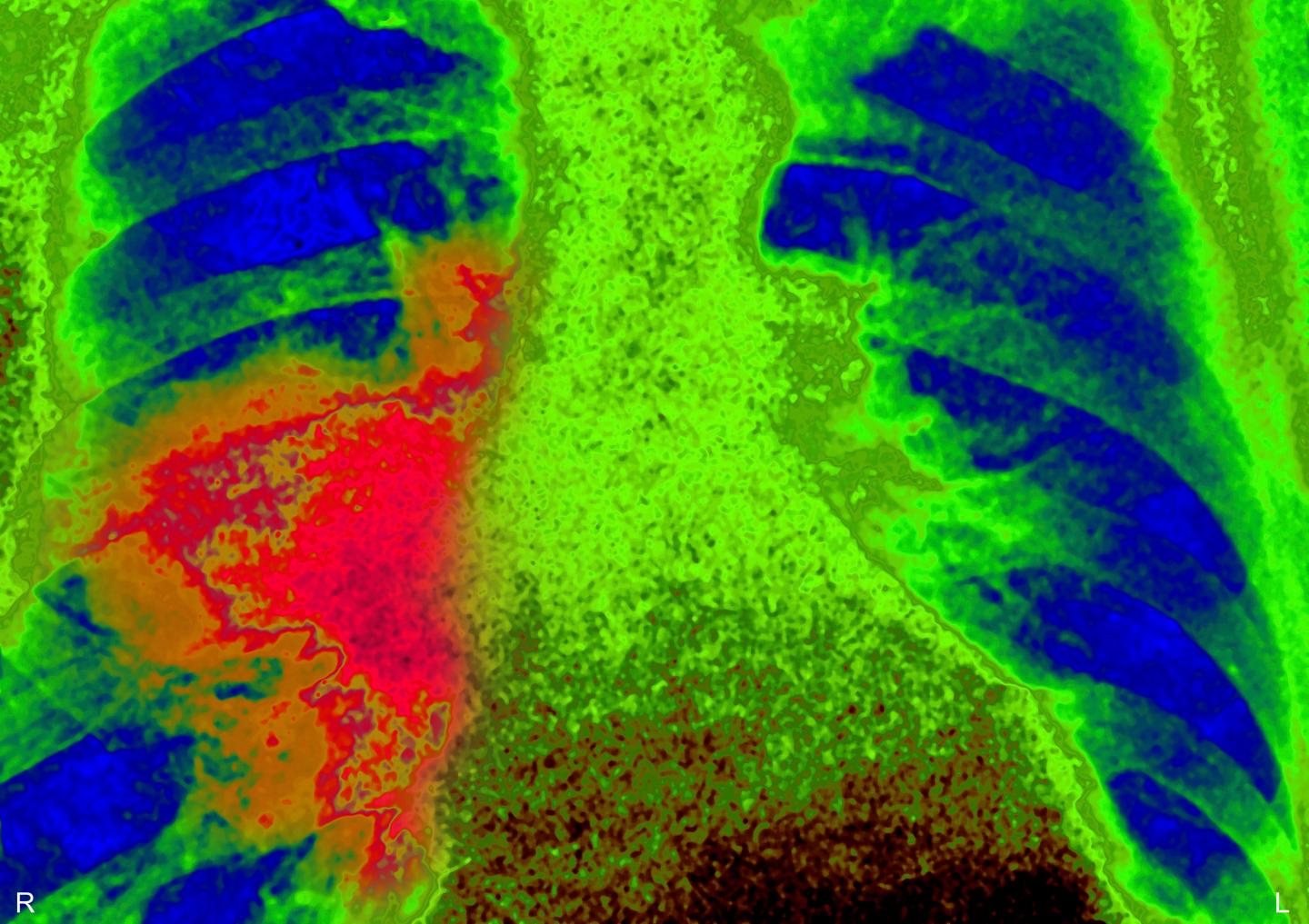 Lung Cancer, X-Ray