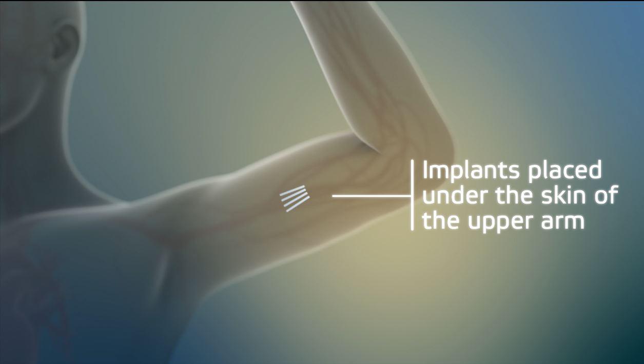 The First Implant to Treat Opioid Addiction Just Got Approved
