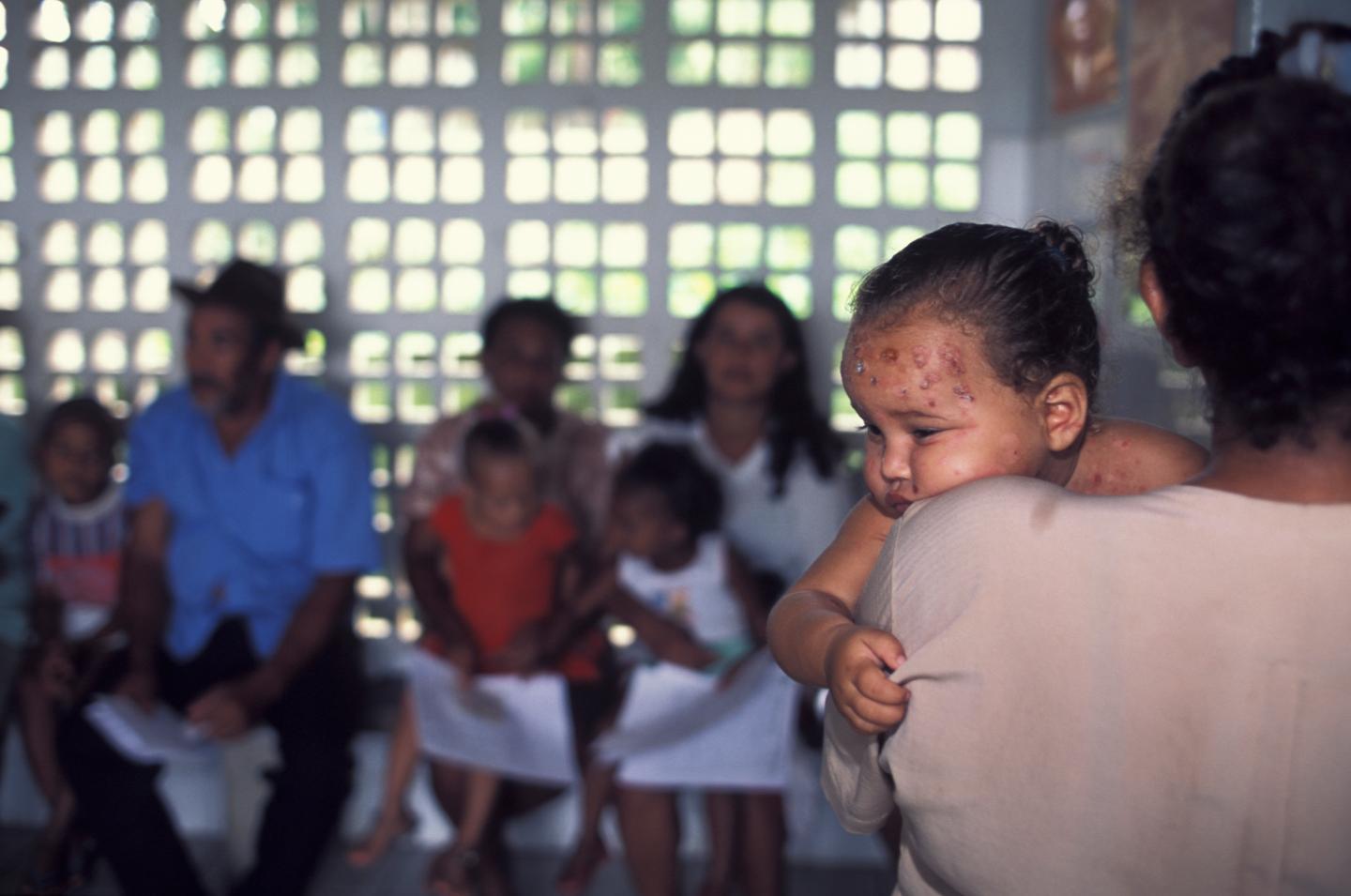 One-year old baby suffering from skin ulcers on face waits