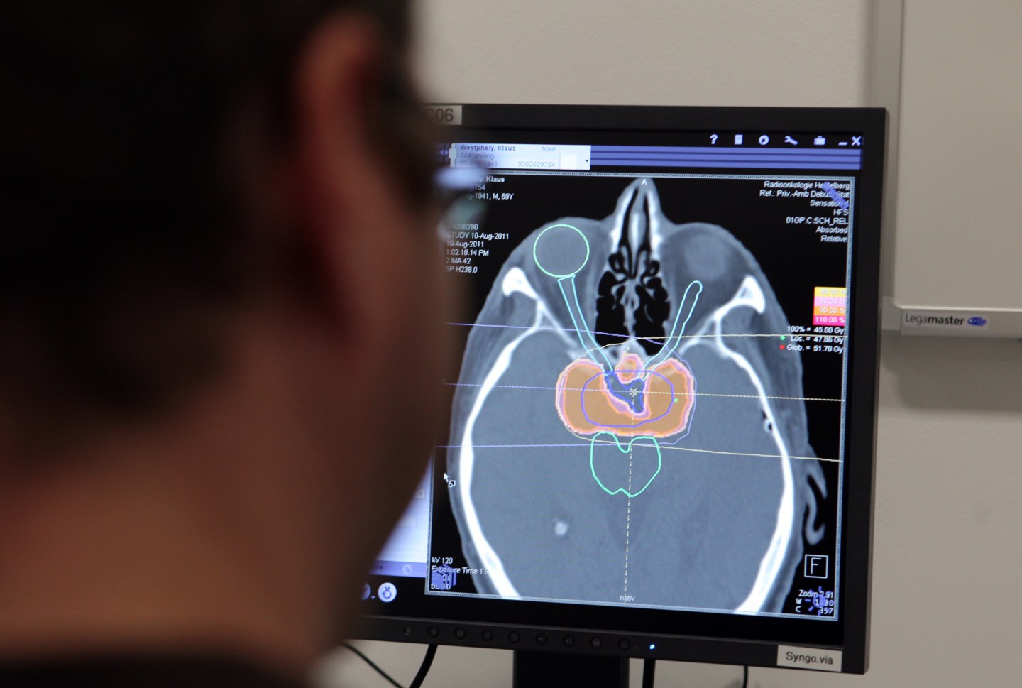 A medical technician monitors a scan of a patient's brain during cancer treatment in Germany.