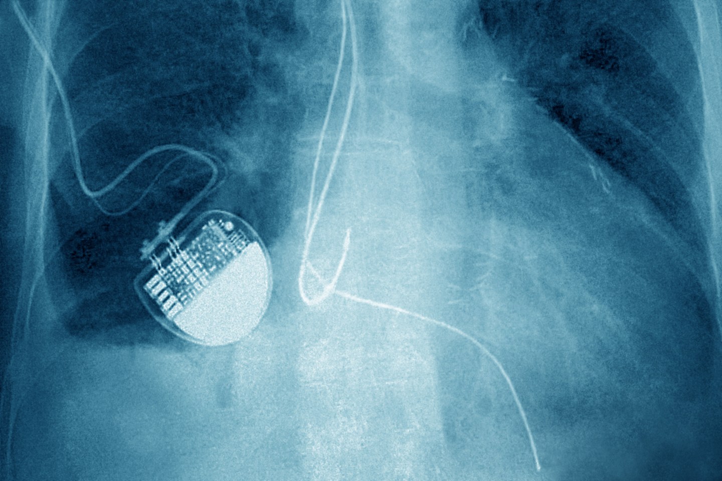 Implanted Pacemaker seen on a frontal chest x-ray.