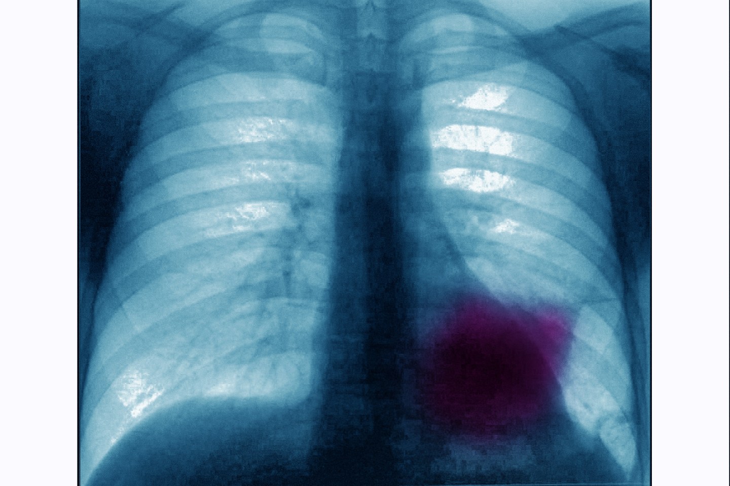 Lung cancer on the left pulmonary lobe, seen on a frontal X-ray of the chest.
