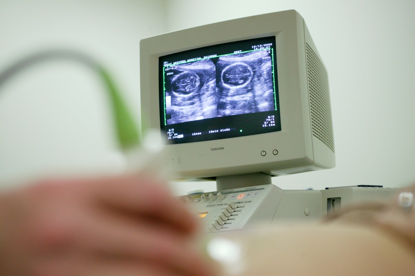 Pregnancy ultrasound