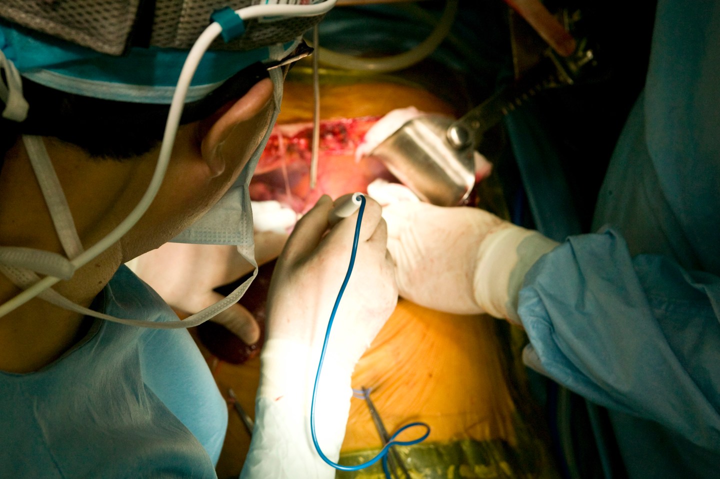 Surgeons performing liver transplant. Samsung Medical Center, Seoul, South Korea.