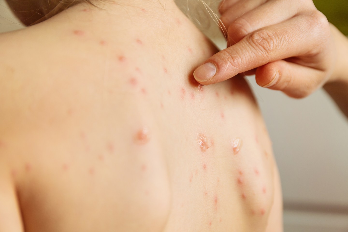 Shingles varicella