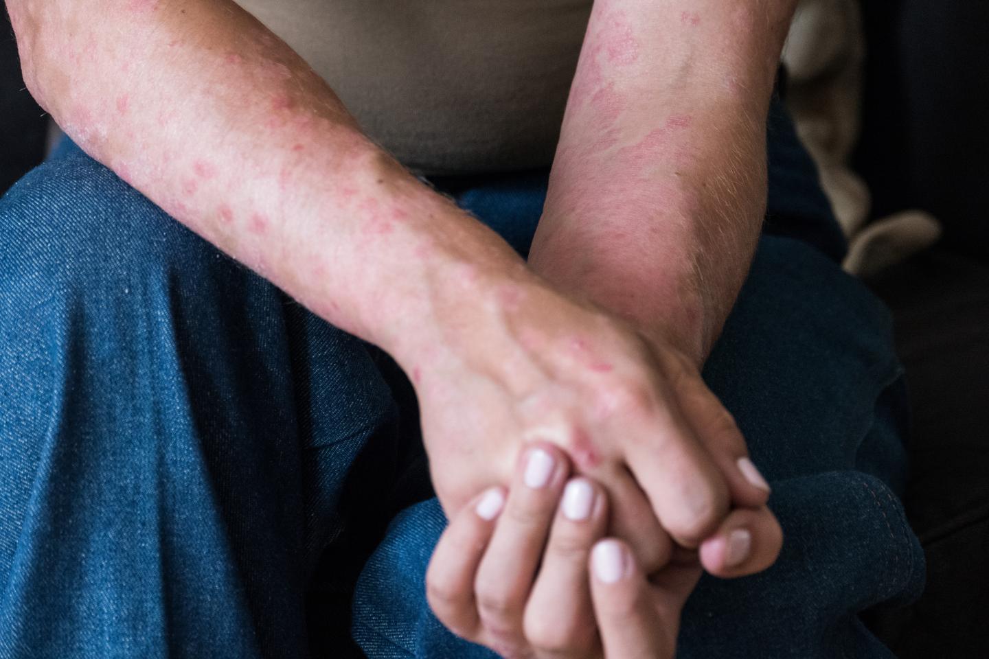 I Dont Want To Get Rid Of My Psoriasis