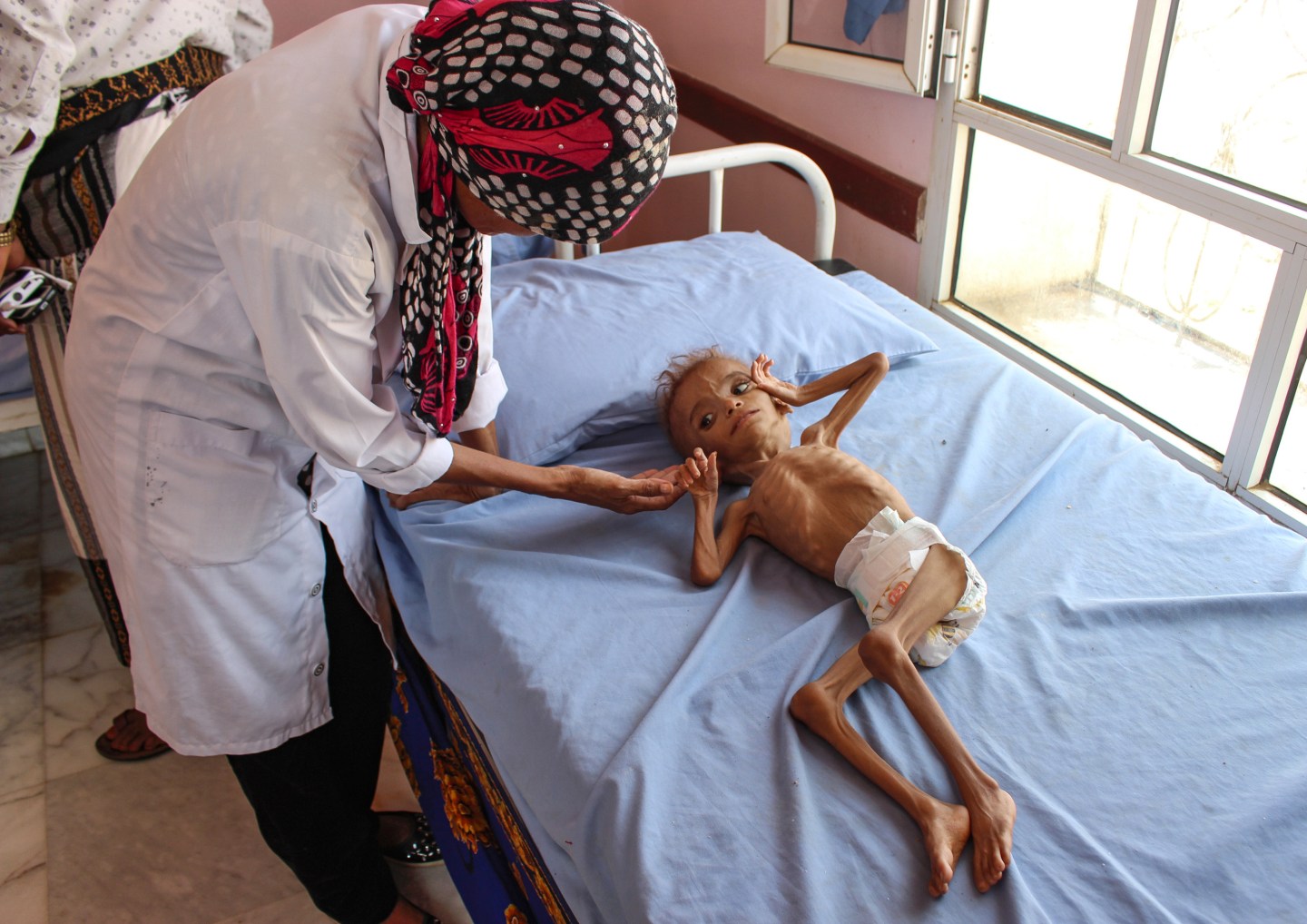 YEMEN-CONFLICT-FAMINE