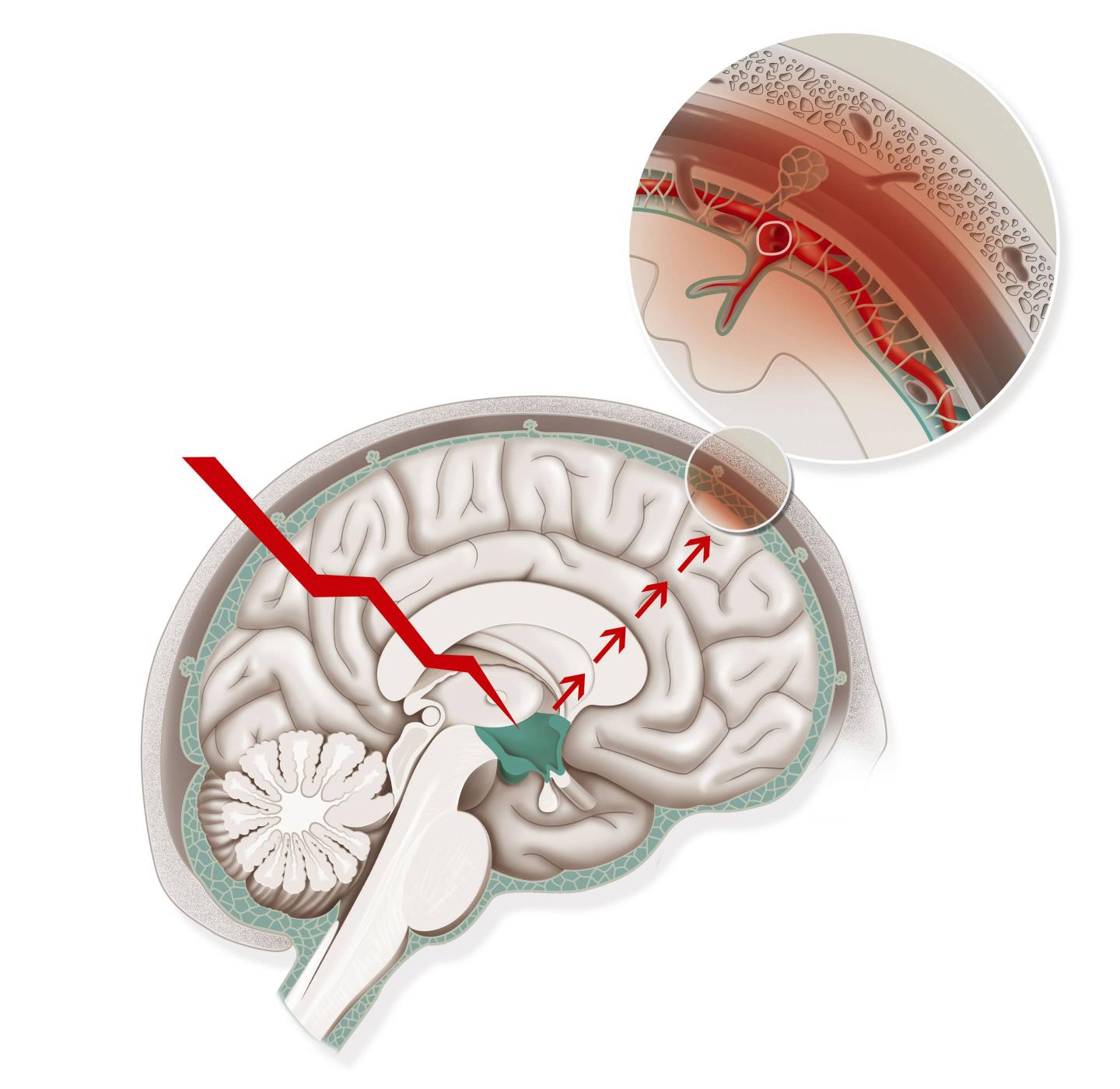 Migraine, Illustration