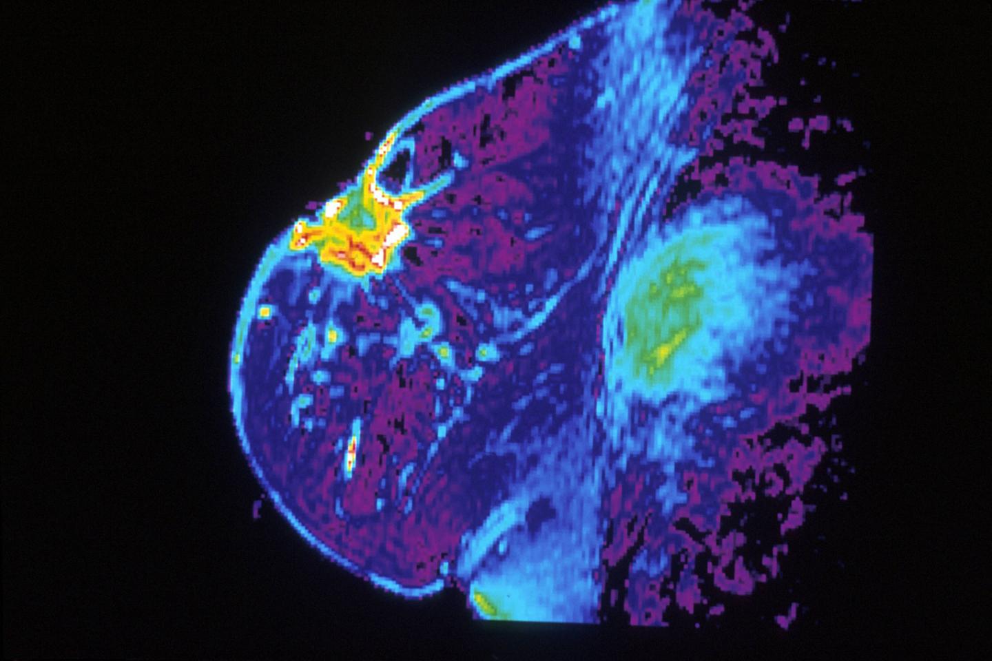 Breast Cancer