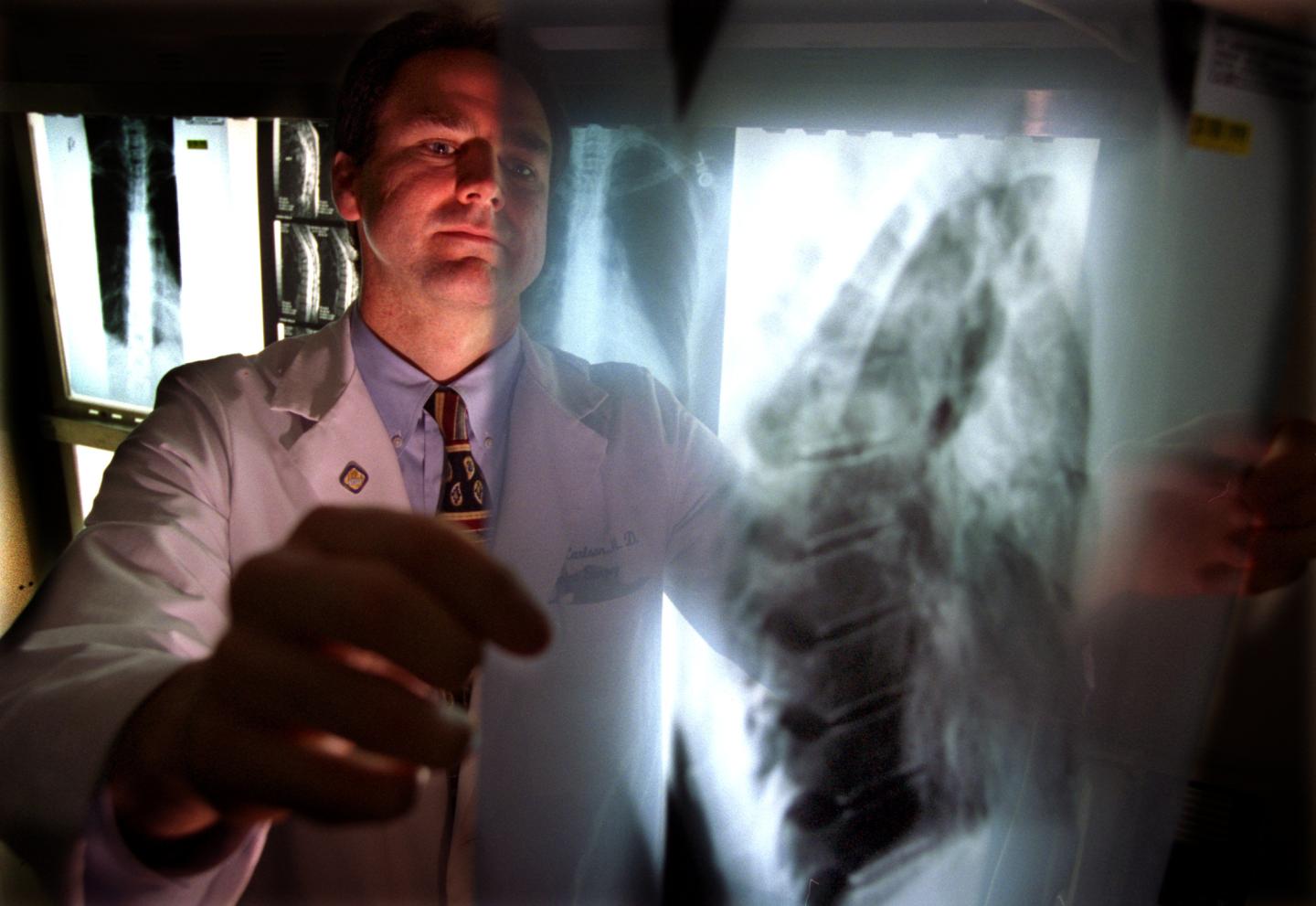 A doctor reviews x-rays of a patient suffering from a form of cancer called multiple myeloma.