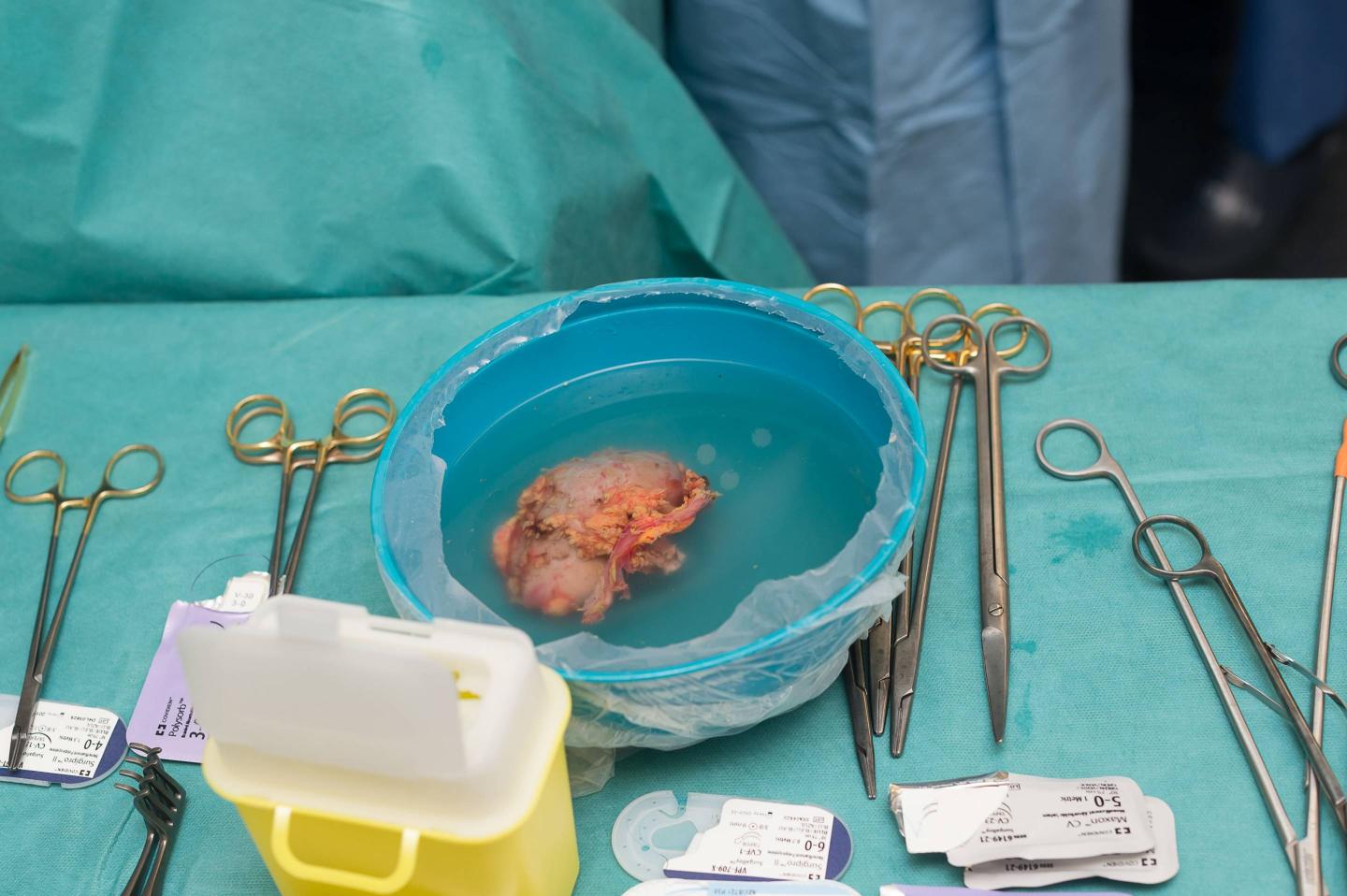 KIDNEY TRANSPLANT