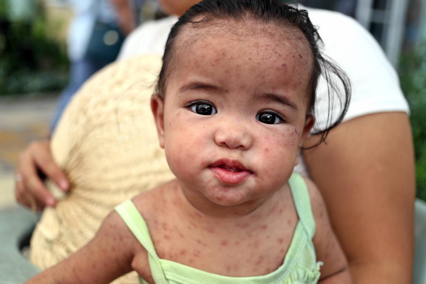 Measles