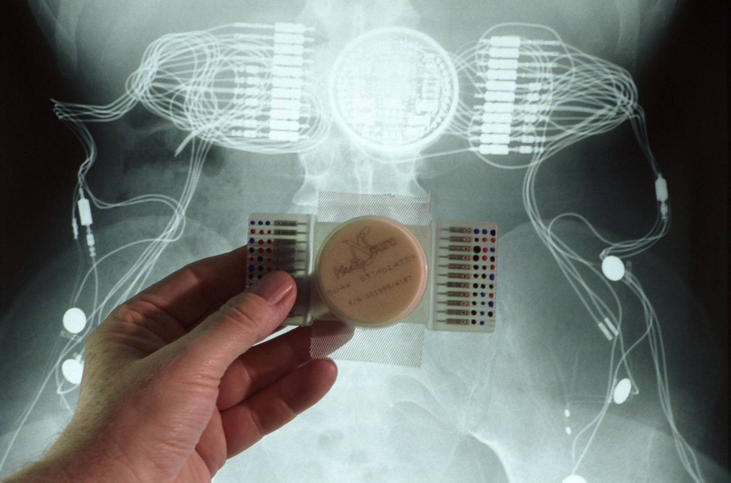Artificial intelligence played an essential role in helping a paraplegic patient walk by interpreting the electrical signals emitted by the body.