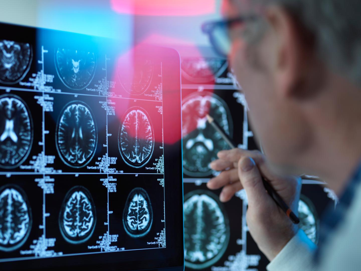 Biogen Alzheimers Drug Data