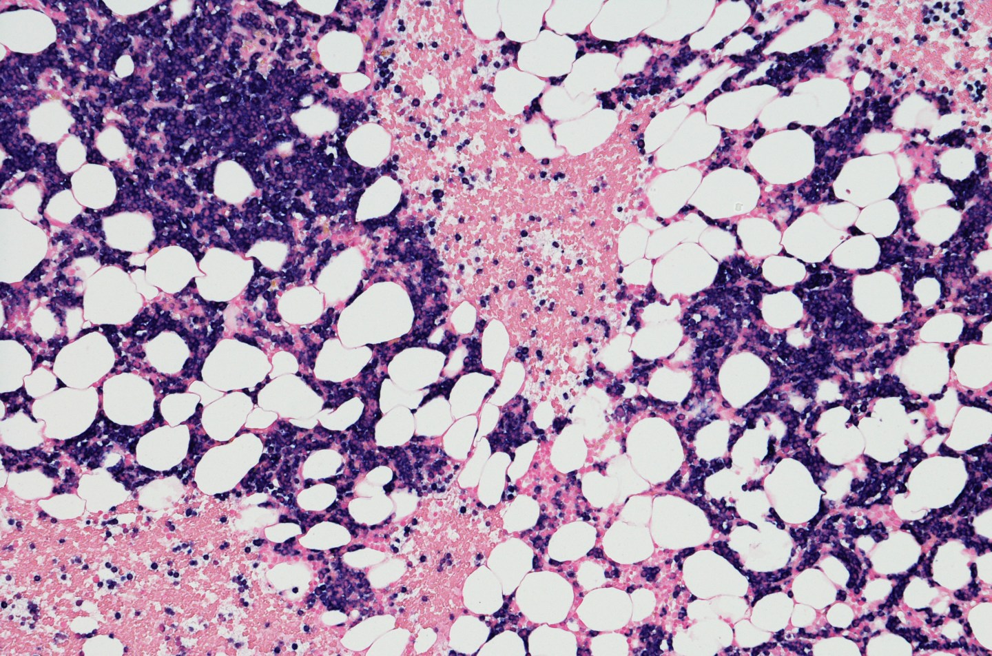 Multiple myeloma MMRF
