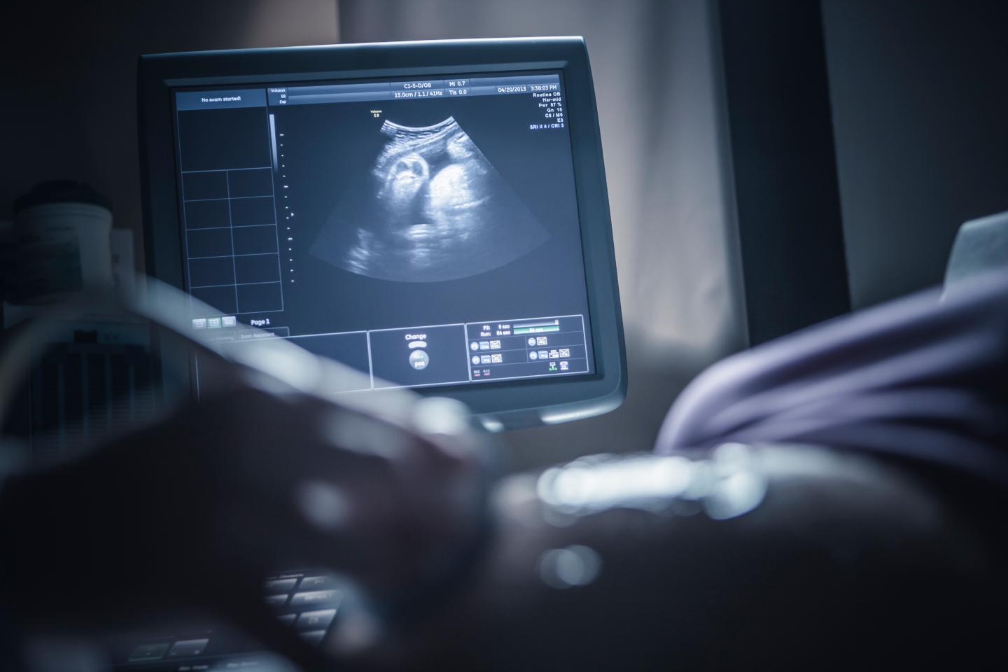 A newborn caught COVID-19 from his mother through the placenta, French doctors say
