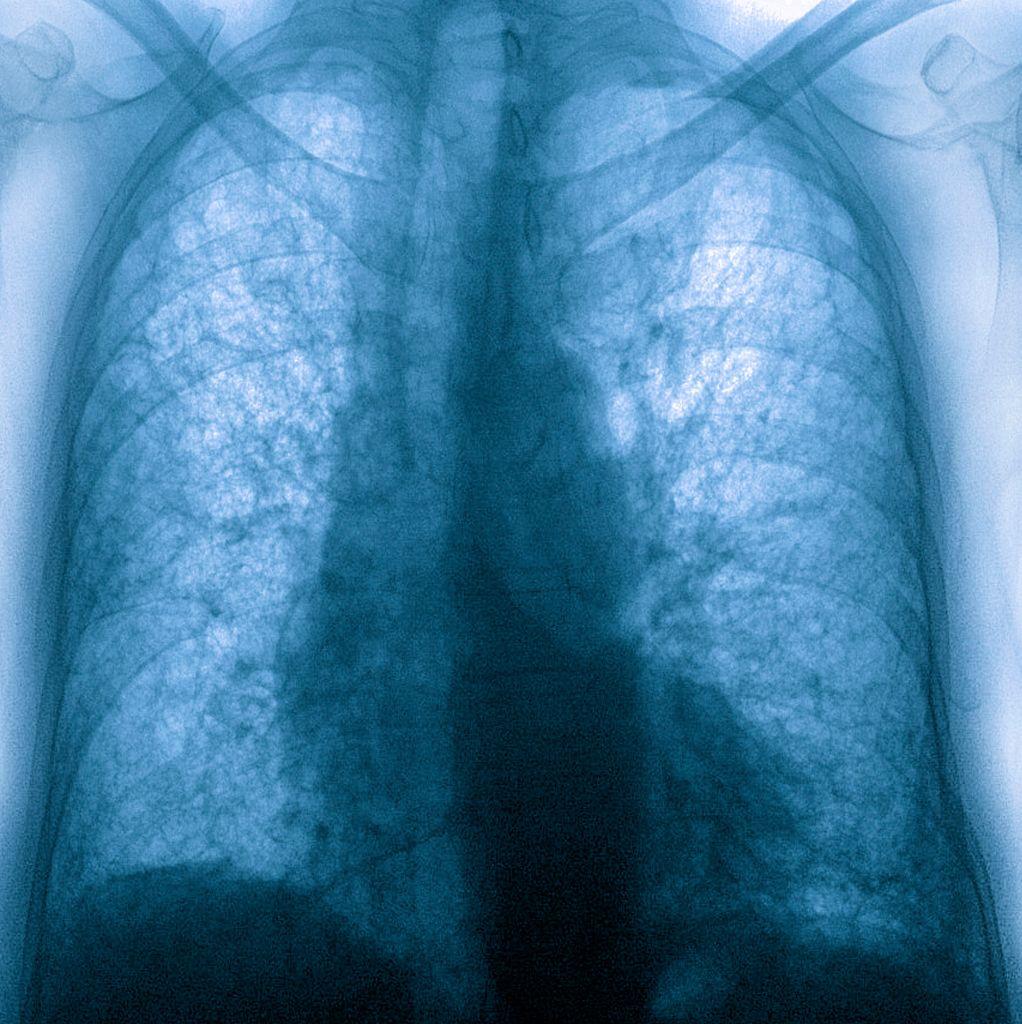 A lung X-ray showing pulmonary fibrosis