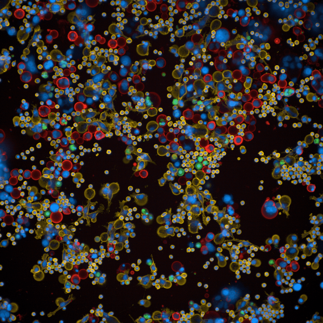 Microscopy image of cancer cells