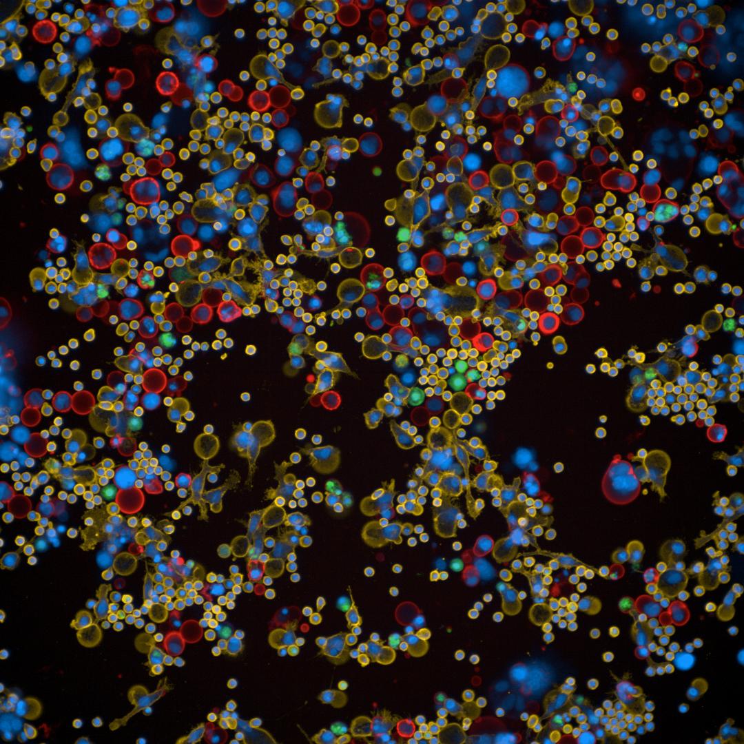 Microscopy image of cancer cells