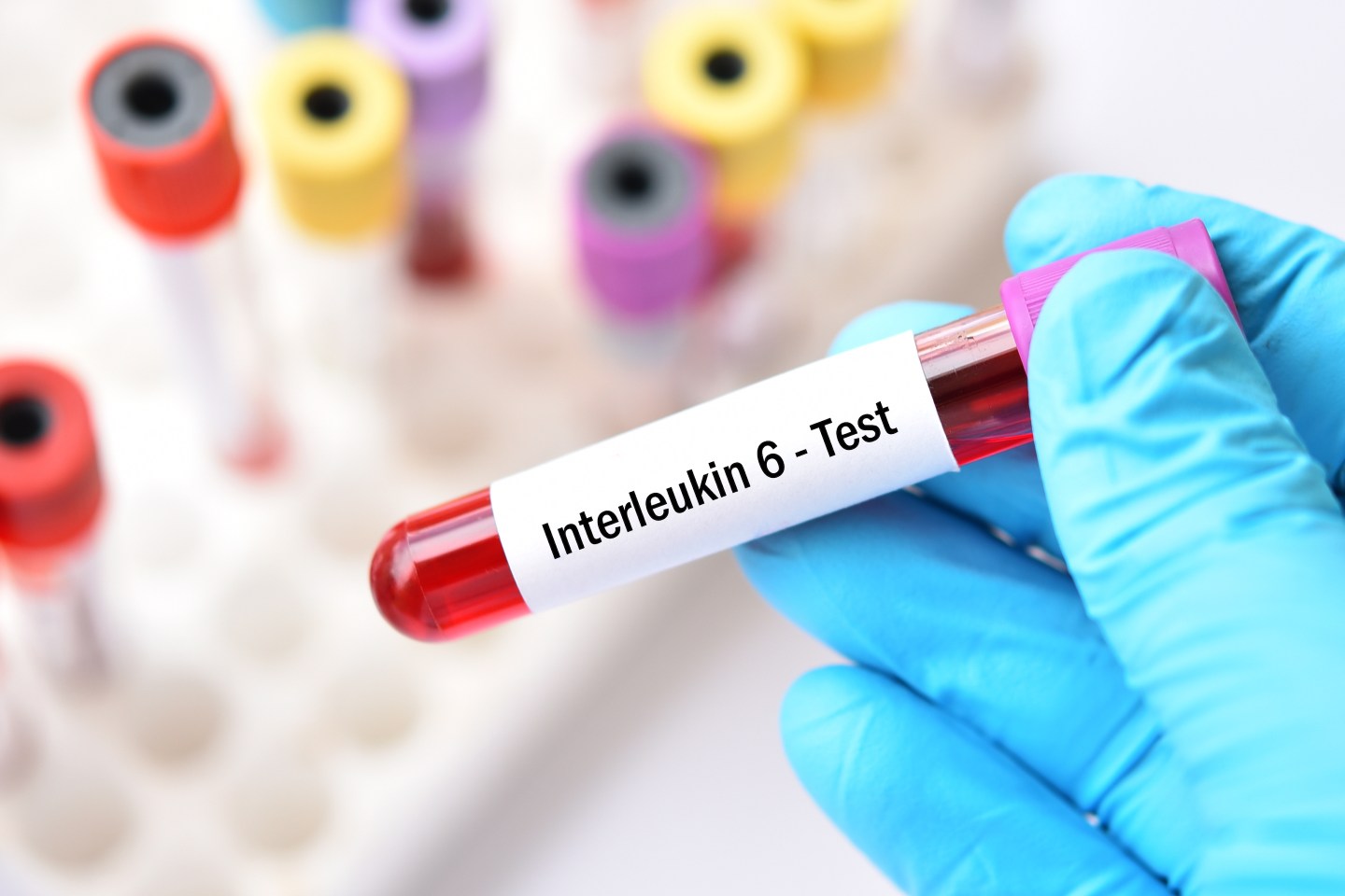 WHO: Drug that blocks immune system overload reduces COVID-19 deaths