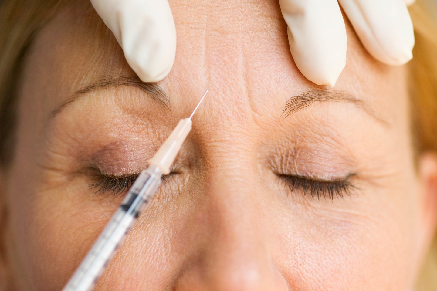 Worksheet-Botox