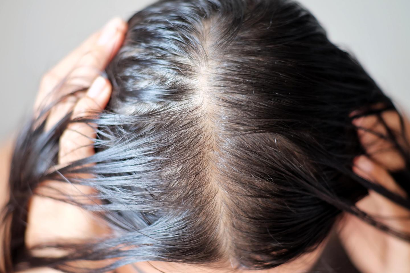 Photo showing hair loss