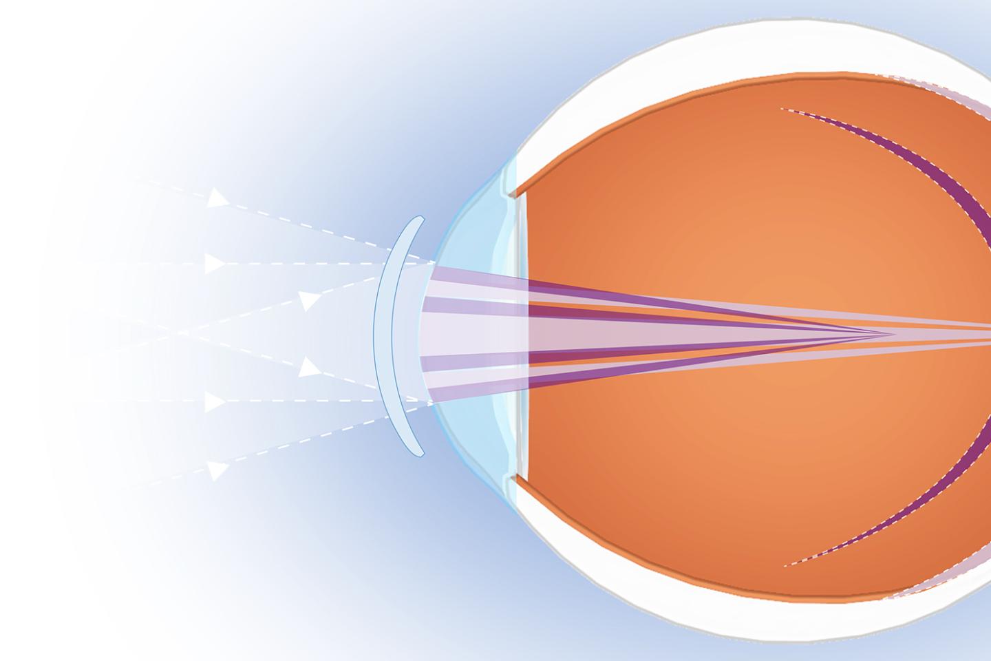 A new contact lens that slows nearsightedness is a boon for optometrists