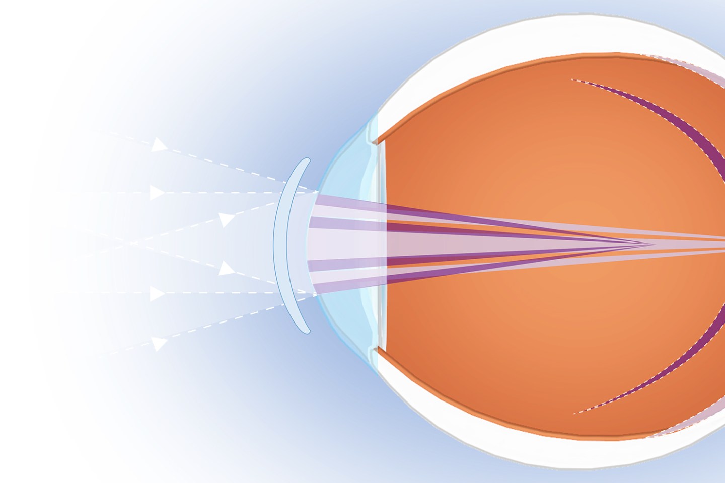 MiSight is the only FDA-approved soft contact lens specifically designed to slow the progression of nearsightedness in children.