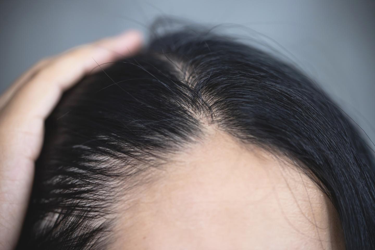 What you should know about PRP treatments for hair loss