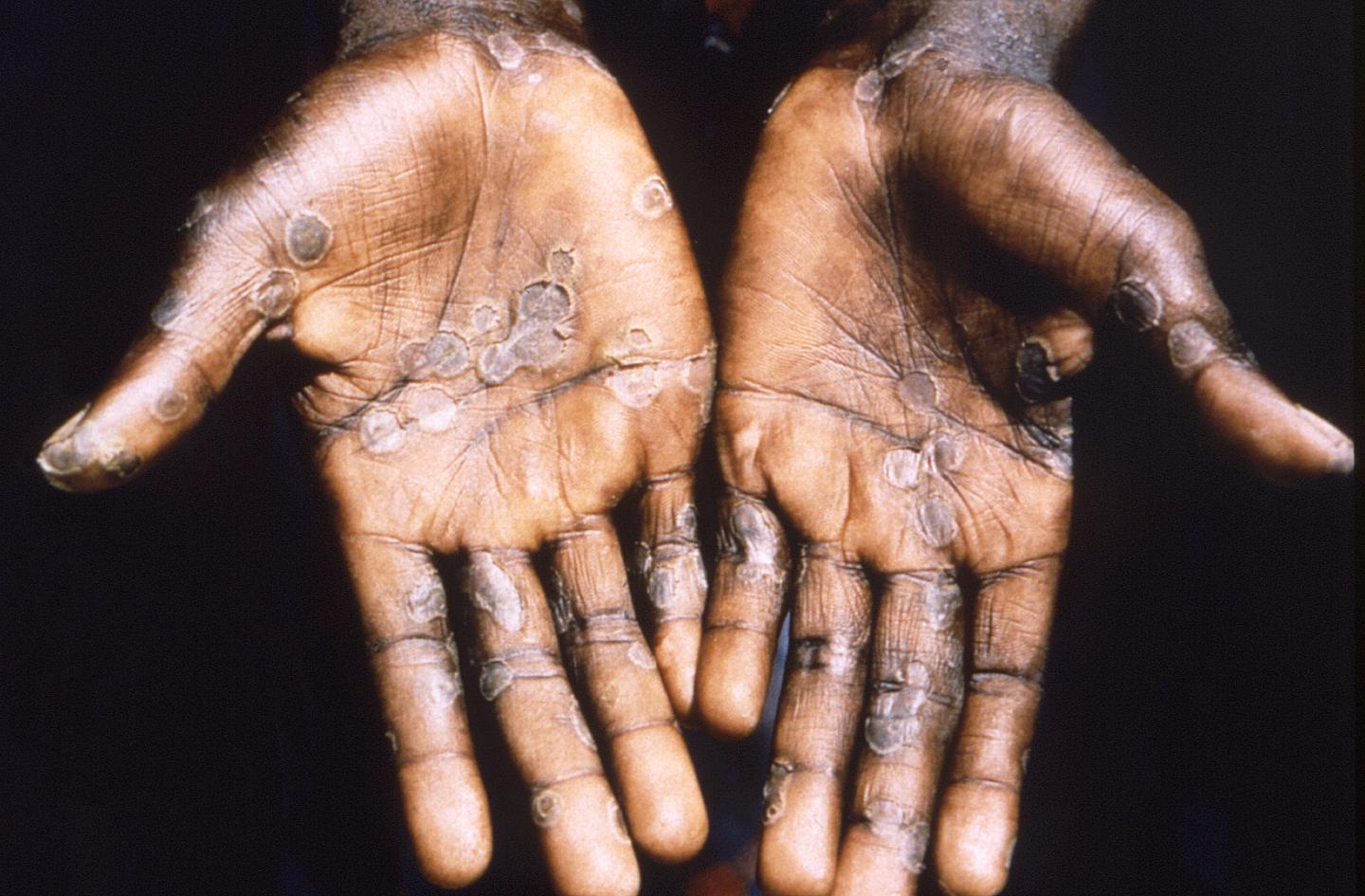 People coming into contact with monkeypox are now being advised to quarantine for 3 weeks