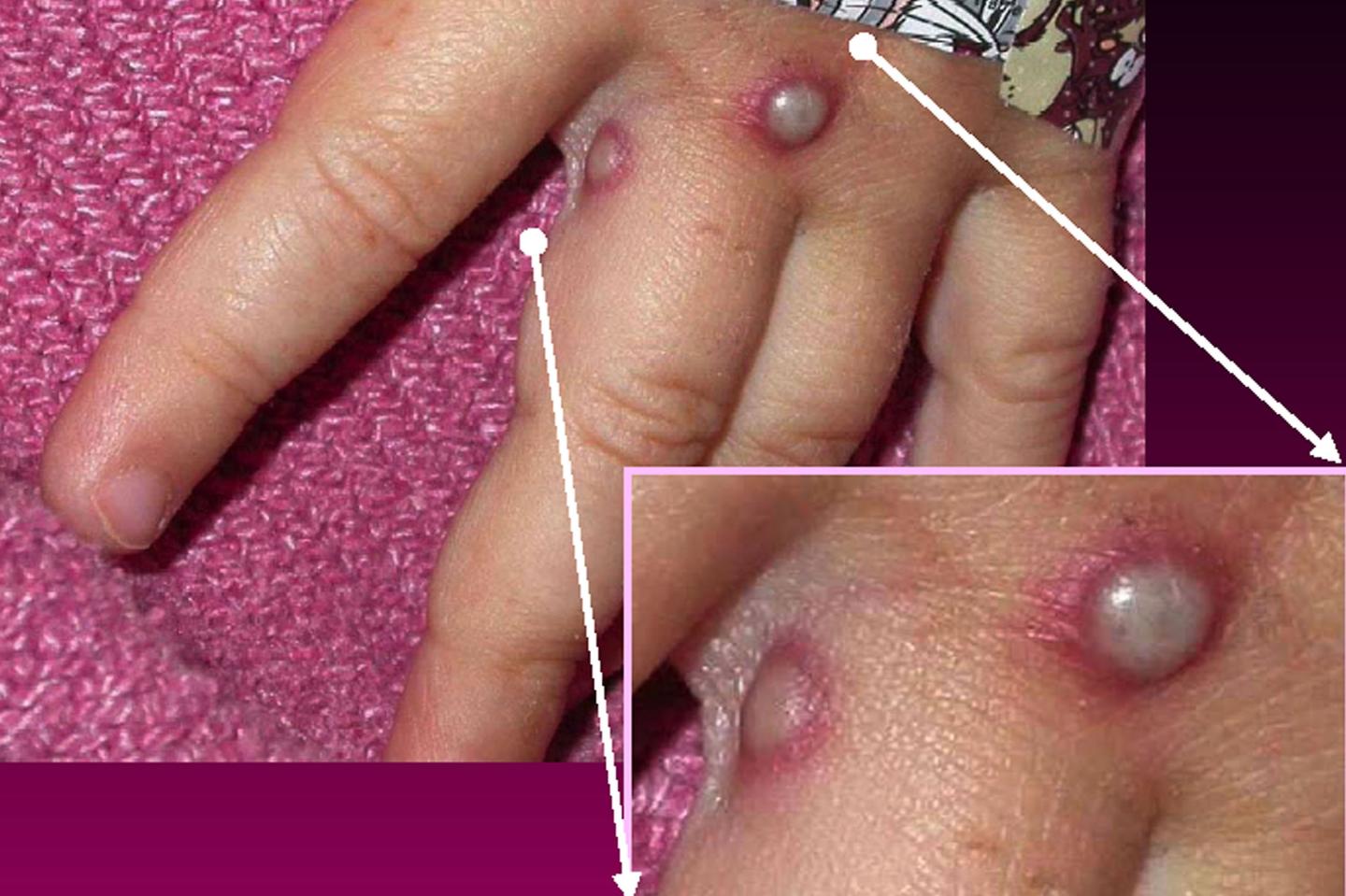 Monkeypox is on the move across Europe with France and Italy reporting first cases, while U.K. more than doubles its numbers