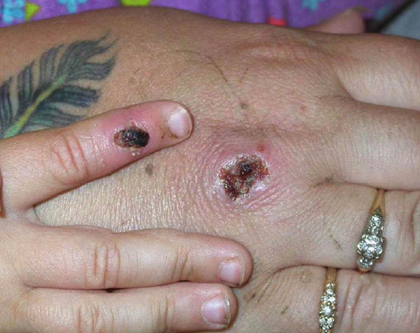 Possible monkeypox infection identified in NYC, officials say