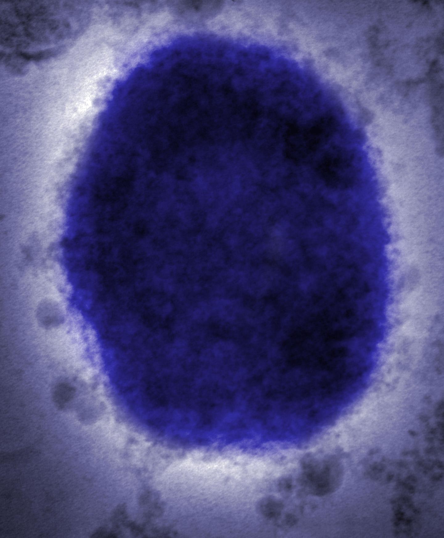New York City case is positive for poxvirus; monkeypox confirmation pending, health officials say