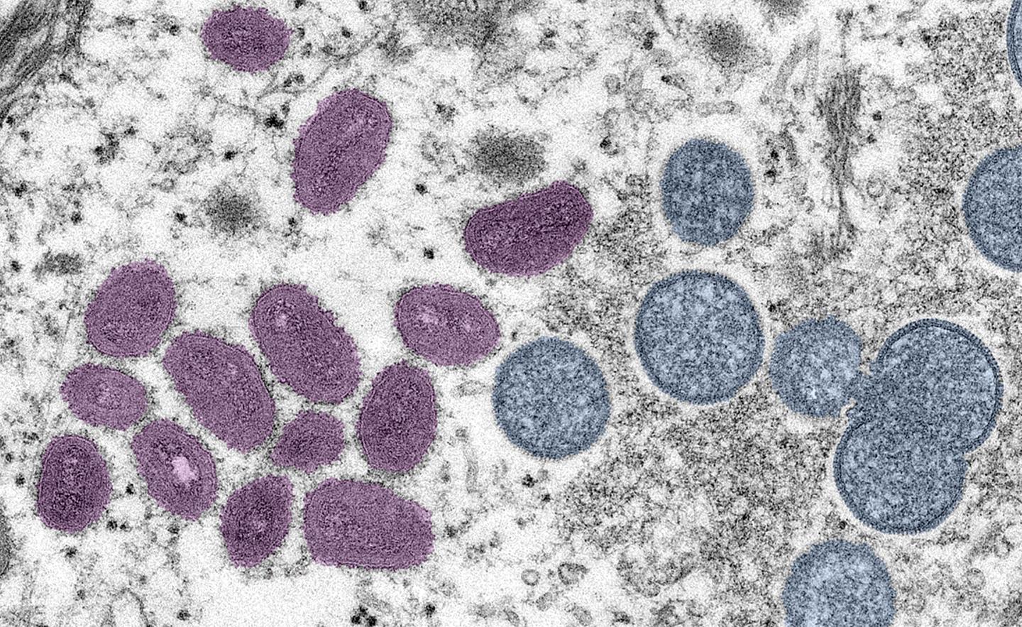 ‘All Americans should get educated about this disease’: Testing must increase to bring U.S. monkeypox outbreak under control, health officials say