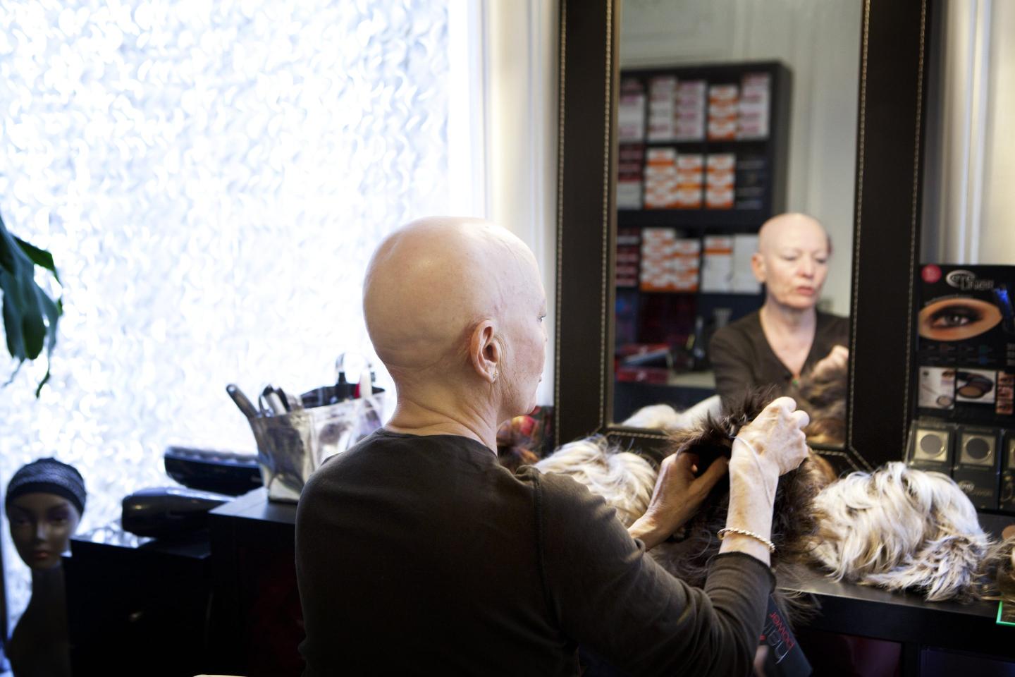 FDA approves historic alopecia treatment