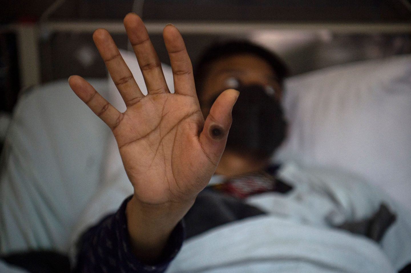 A monkeypox patient in Peru. The WHO has voiced concerns about breakthrough infections.