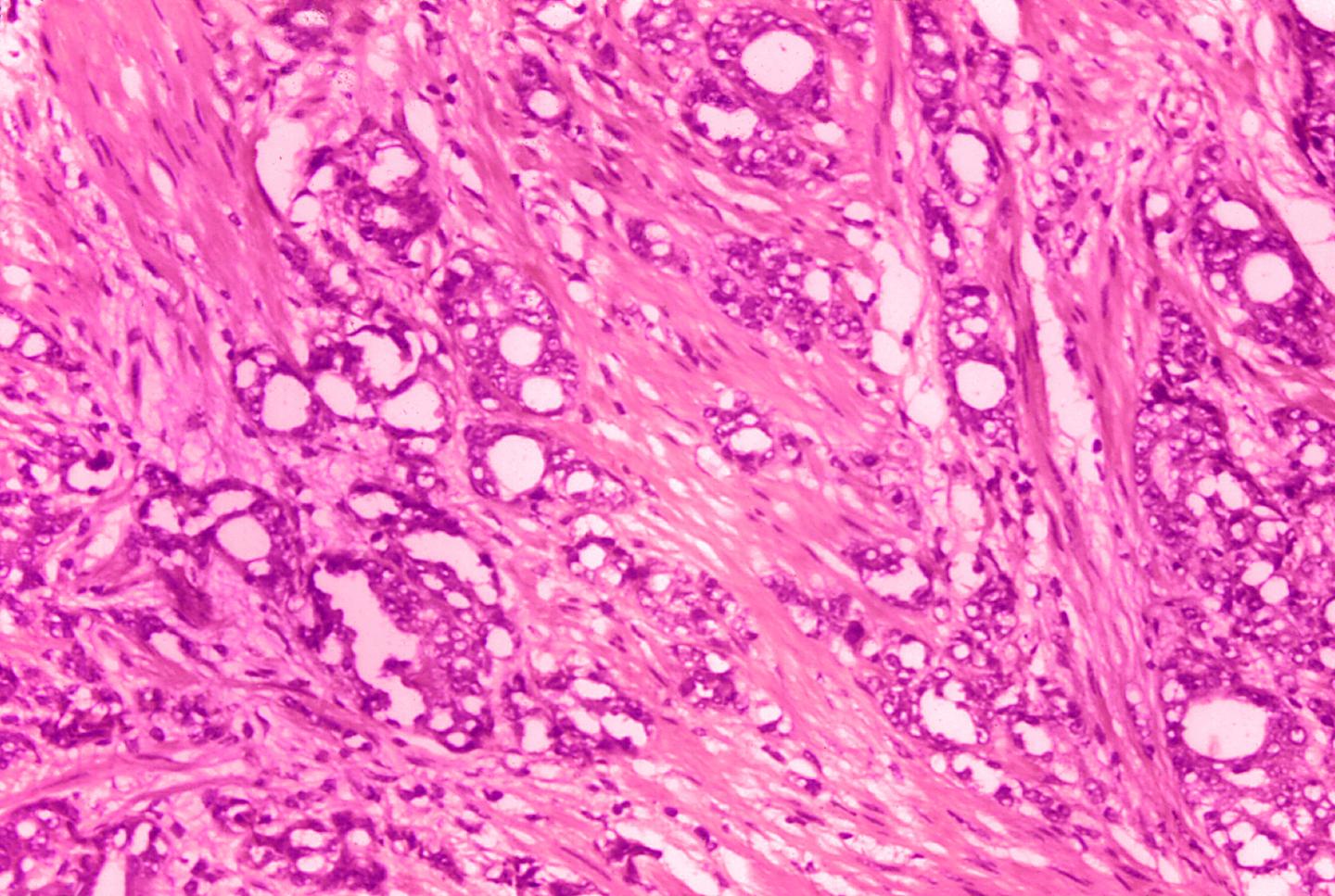Prostate cancer