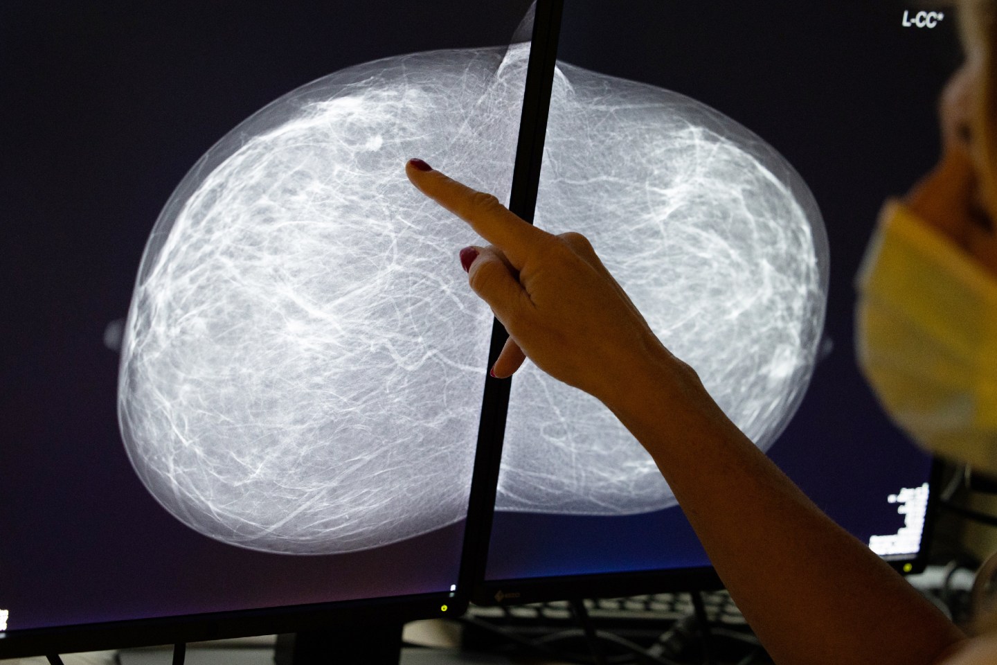 Illustration shows a mammography at the breast clinic.