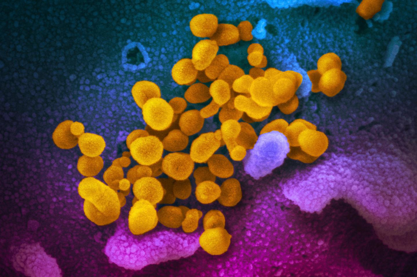 1 in 10 people get long COVID after Omicron, NIH study finds