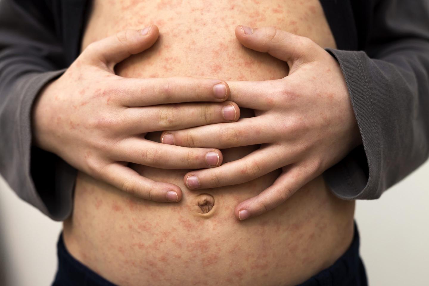 “The increased number of measles importations seen in recent weeks is reflective of a rise in global measles cases and a growing global threat from the disease,” the U.S. Centers for Disease Control and Prevention said in a Jan. 25 bulletin to health care providers.