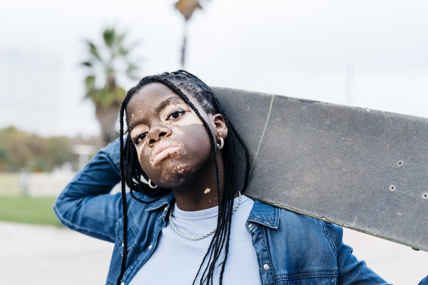 More than 24 million Americans, by some estimates up to 50 million, have an autoimmune disorder — diseases such as vitiligo (as pictured), lupus, rheumatoid arthritis, multiple sclerosis, and dozens more.