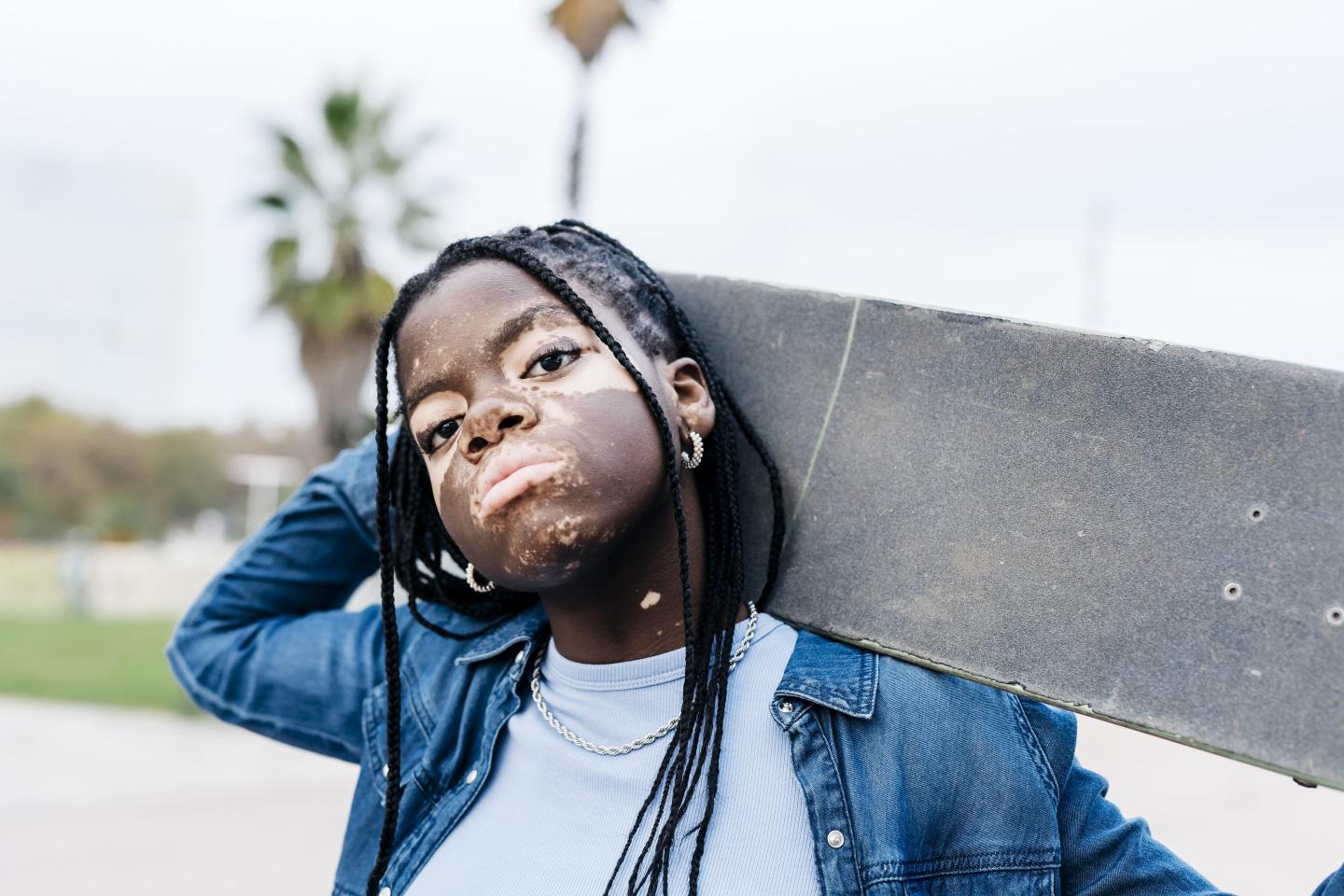 More than 24 million Americans, by some estimates up to 50 million, have an autoimmune disorder — diseases such as vitiligo (as pictured), lupus, rheumatoid arthritis, multiple sclerosis, and dozens more.