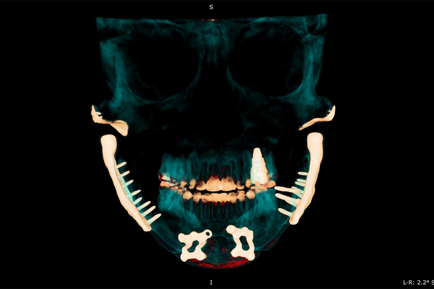 The horrors of TMJ: Chronic pain, metal jaws, and futile treatments