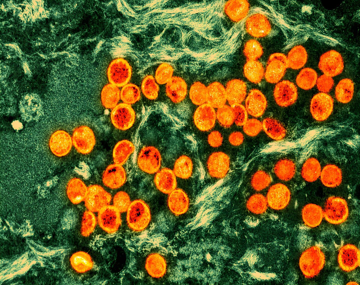 Sweden reports 1st case of more infectious form of mpox first identified in Congo