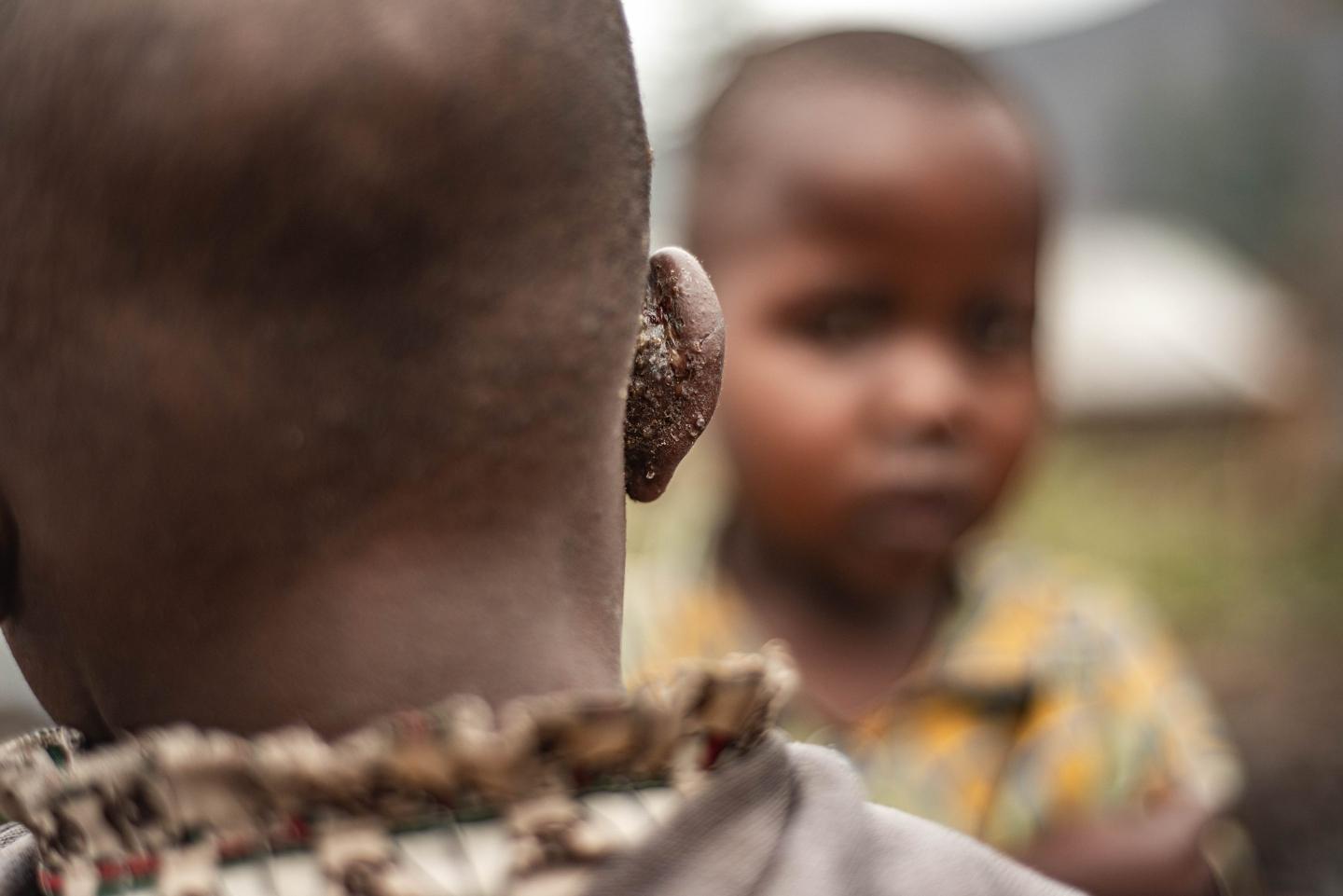 A child caught mpox is seen at a hospital in the Nyiragongo territory near Goma
