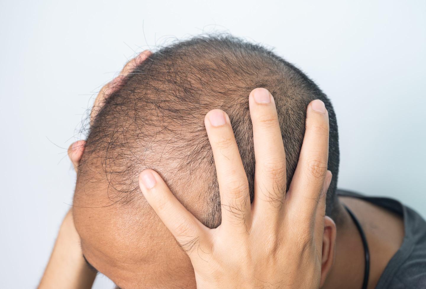 balding head